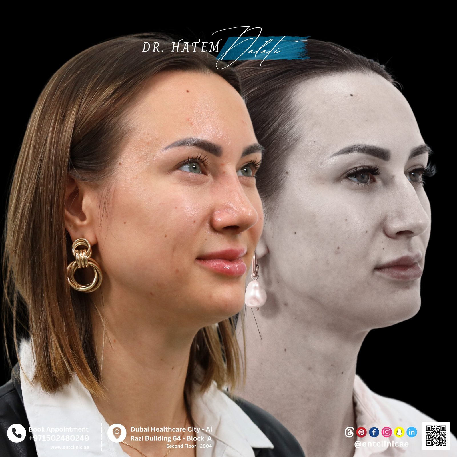 DR HATEM DALATI RHINOPLASTY NOSE JOB REVISION DUBAI UAE NATURAL LOOK PRICE ENT CONSULTANT SURGEON SURGERY