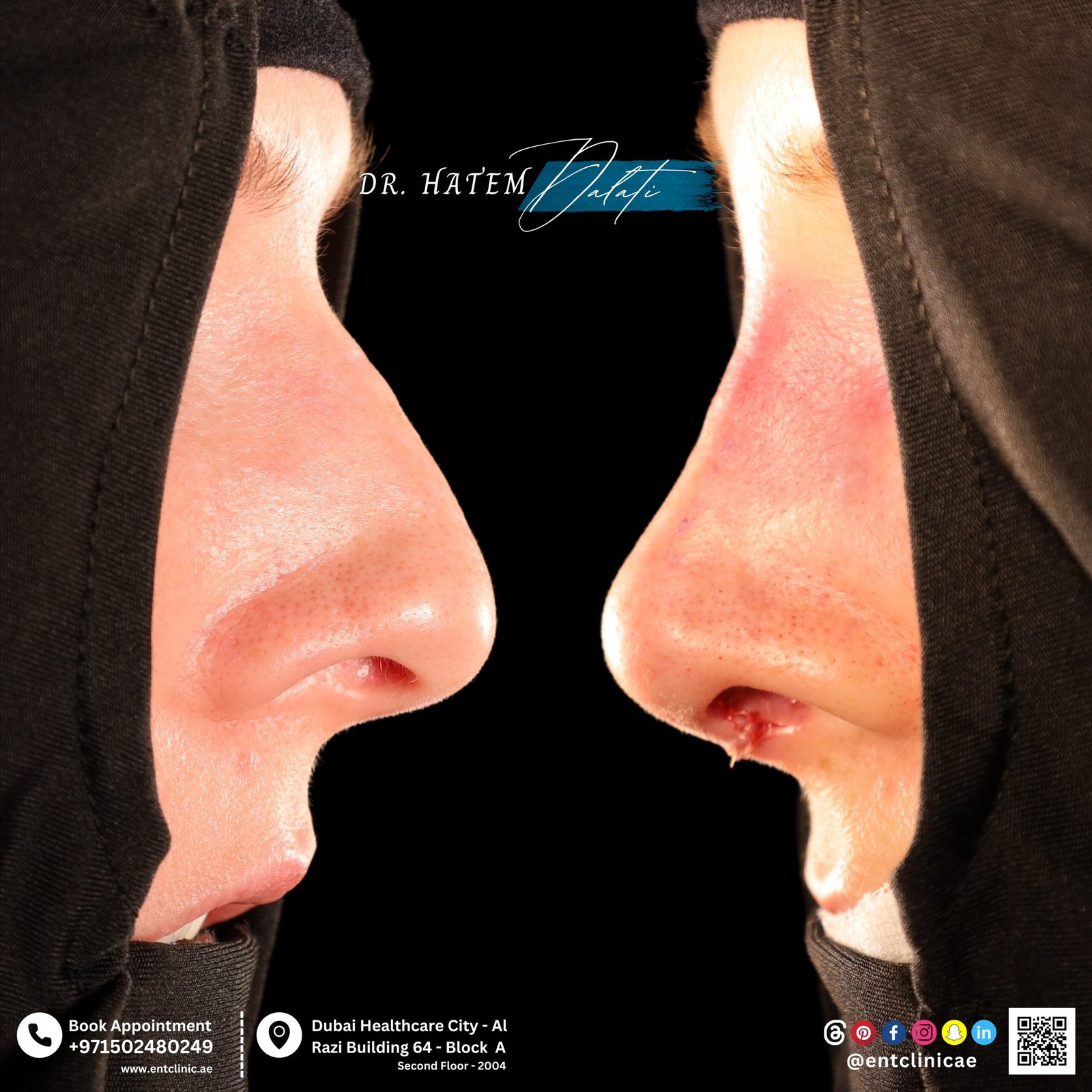 DR HATEM DALATI RHINOPLASTY NOSE JOB REVISION DUBAI UAE NATURAL LOOK PRICE ENT CONSULTANT SURGEON SURGERY