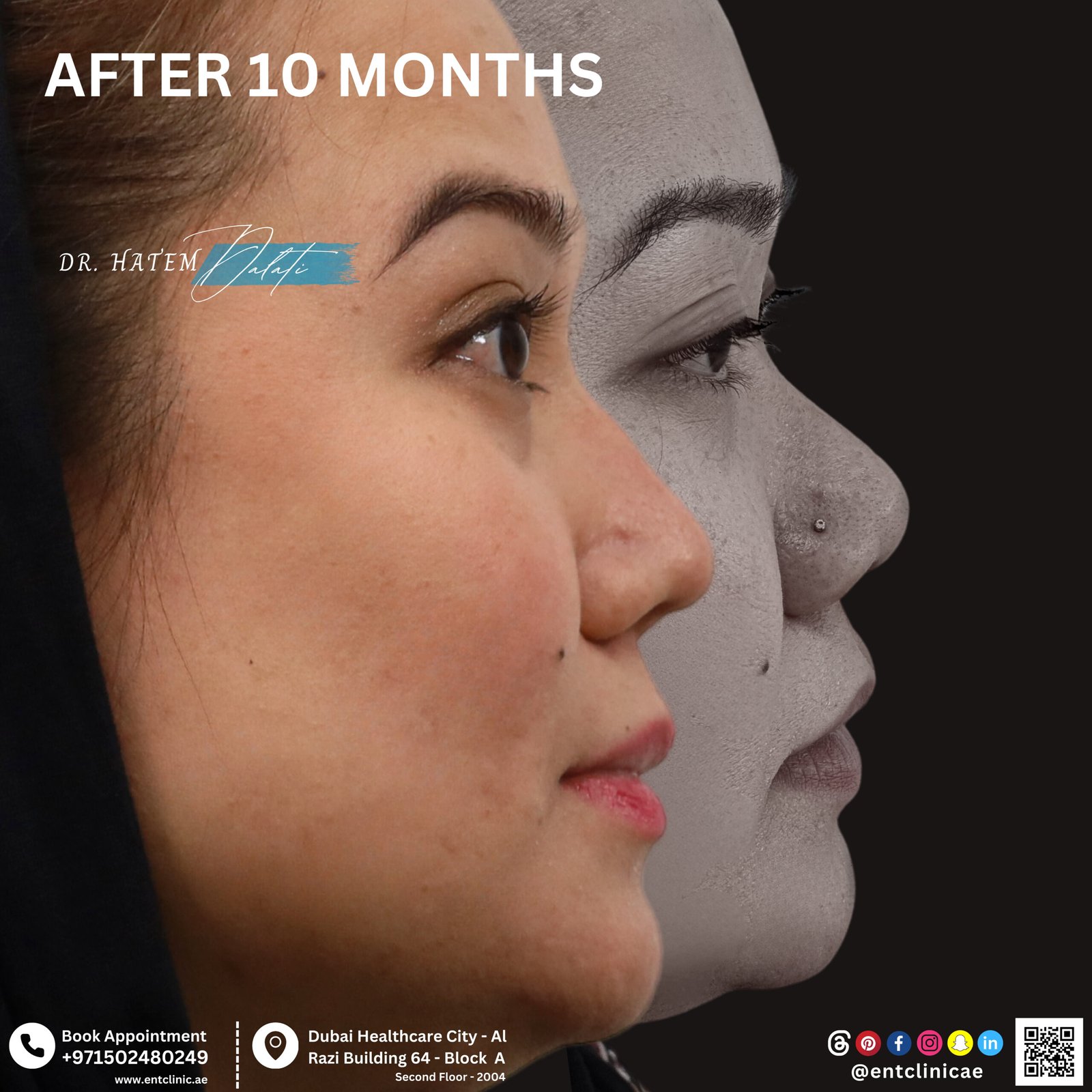 DR HATEM DALATI RHINOPLASTY NOSE JOB REVISION DUBAI UAE NATURAL LOOK PRICE ENT CONSULTANT SURGEON SURGERY