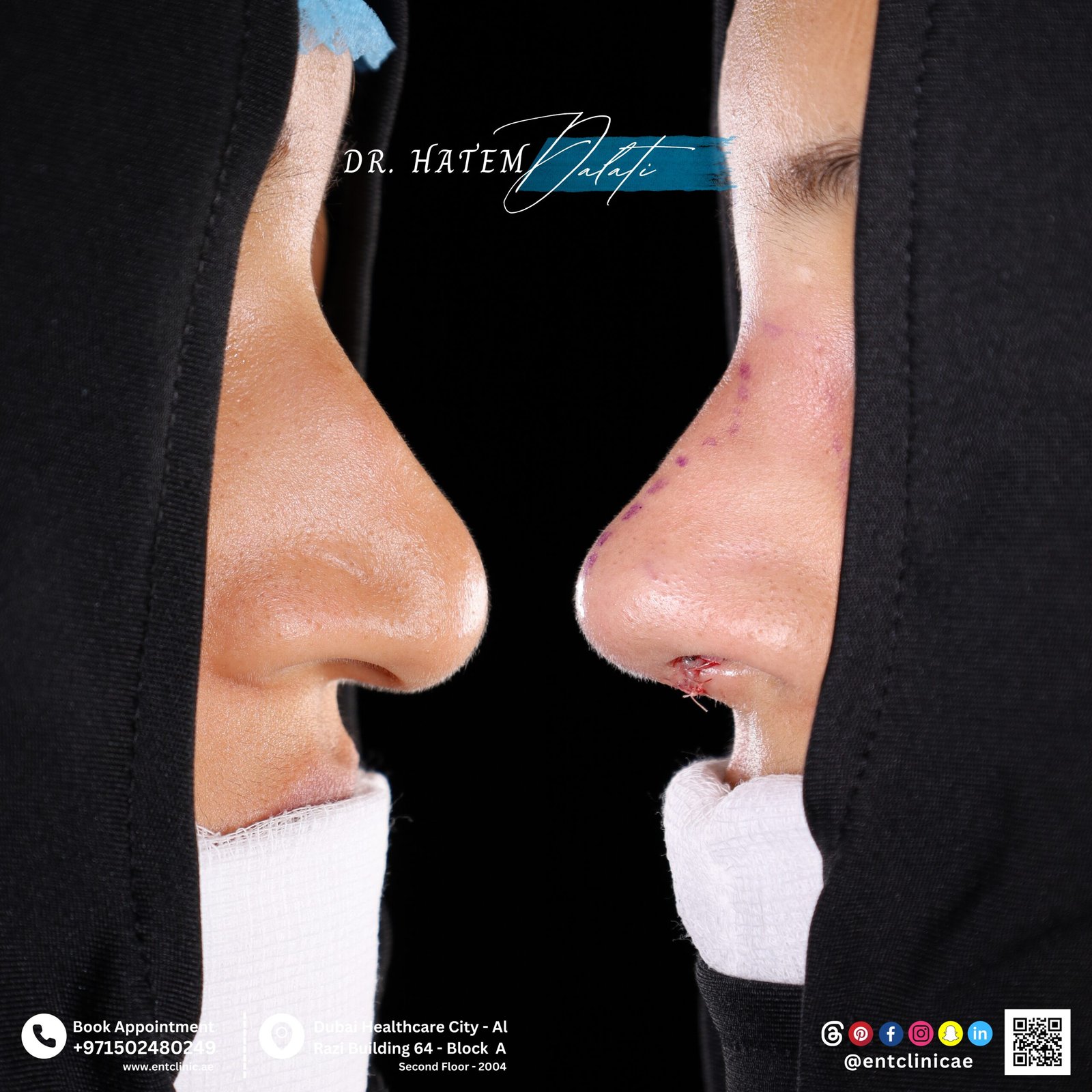 DR HATEM DALATI RHINOPLASTY NOSE JOB REVISION DUBAI UAE NATURAL LOOK PRICE ENT CONSULTANT SURGEON SURGERY