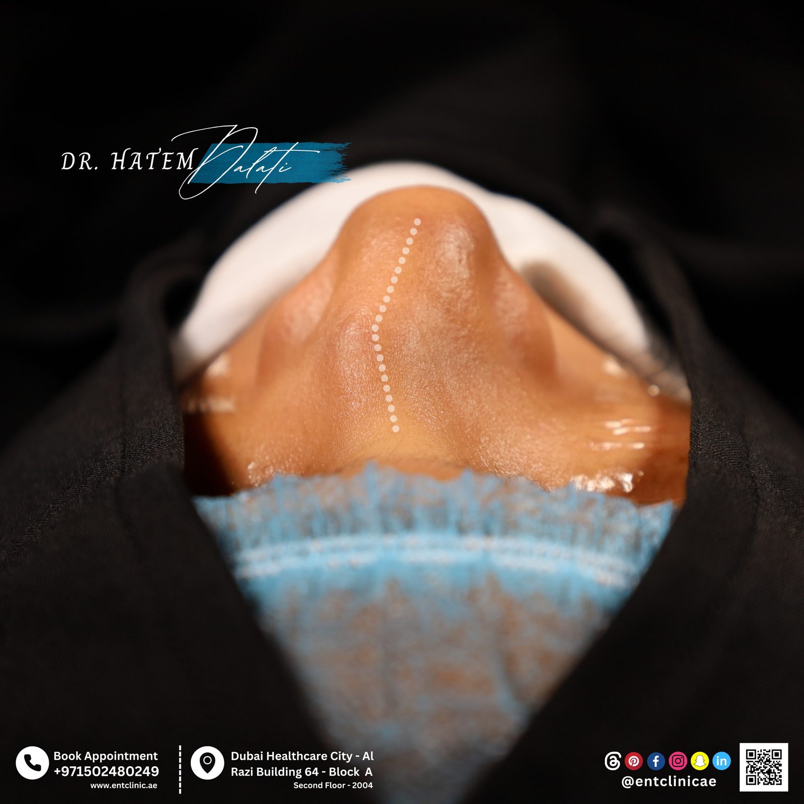 DR HATEM DALATI RHINOPLASTY NOSE JOB REVISION DUBAI UAE NATURAL LOOK PRICE ENT CONSULTANT SURGEON SURGERY