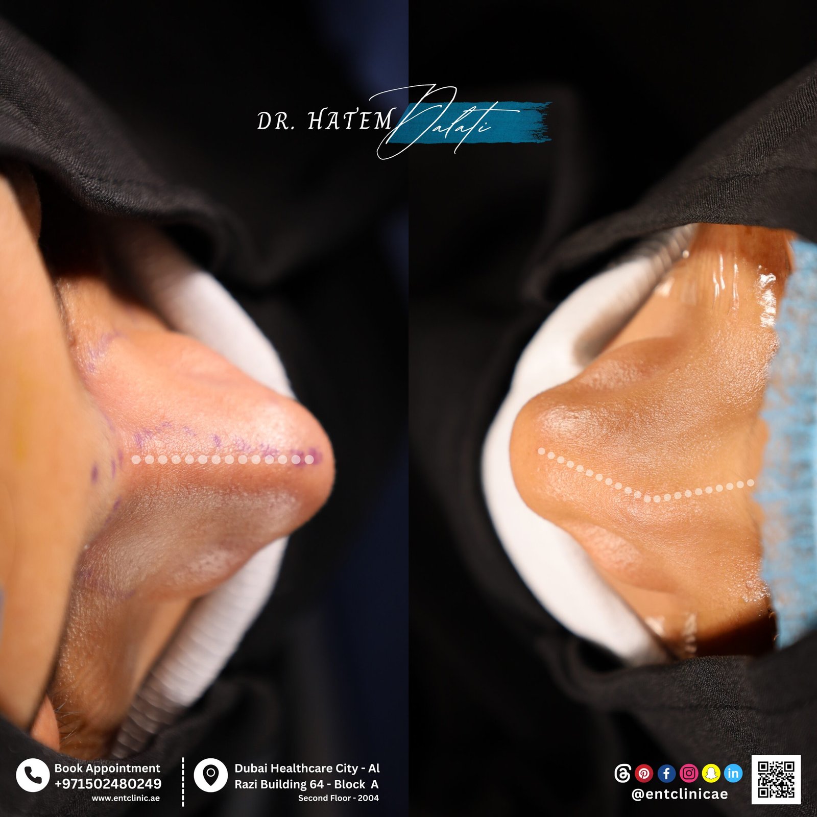 DR HATEM DALATI RHINOPLASTY NOSE JOB REVISION DUBAI UAE NATURAL LOOK PRICE ENT CONSULTANT SURGEON SURGERY