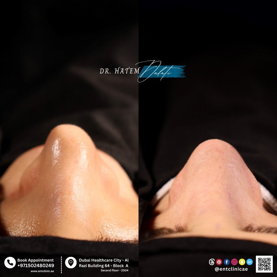 هل زراعة السيليكون أو غور-تكس آمنة لعمليات تجميل الأنف؟ المخاطر، الرفض والغضروف الطبيعي في دبي