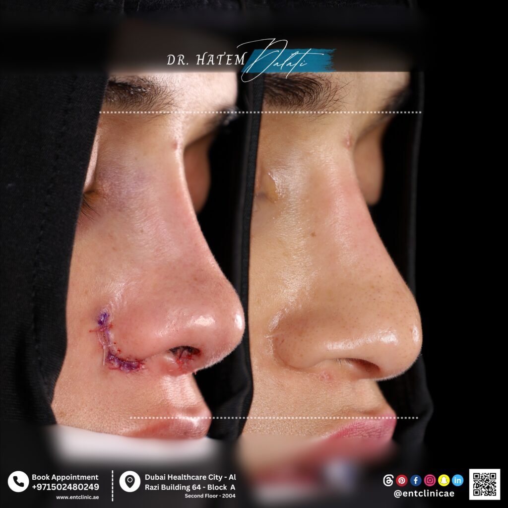 لا تستطيع التنفس بعد جراحة الأنف؟ شرح متلازمة الأنف الفارغ