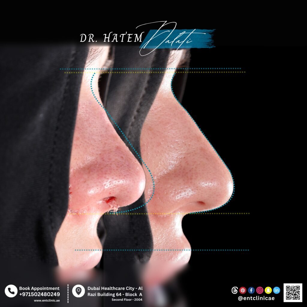 thick skin rhinoplasty Dubai before and after