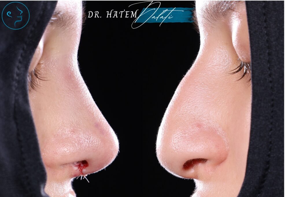 👃 تجميل الأنف للمراهقين: هل يمكن لفتاة أو فتى في سن 16 إجراء عملية تجميل للأنف؟ ما يجب أن يعرفه الأهل 🧑⚕️👨👩👧 👃 تجميل الأنف للمراهقين: هل يمكن لفتاة أو فتى في سن 16 إجراء عملية تجميل للأنف؟ ما يجب أن يعرفه الأهل 🧑⚕️👨👩👧