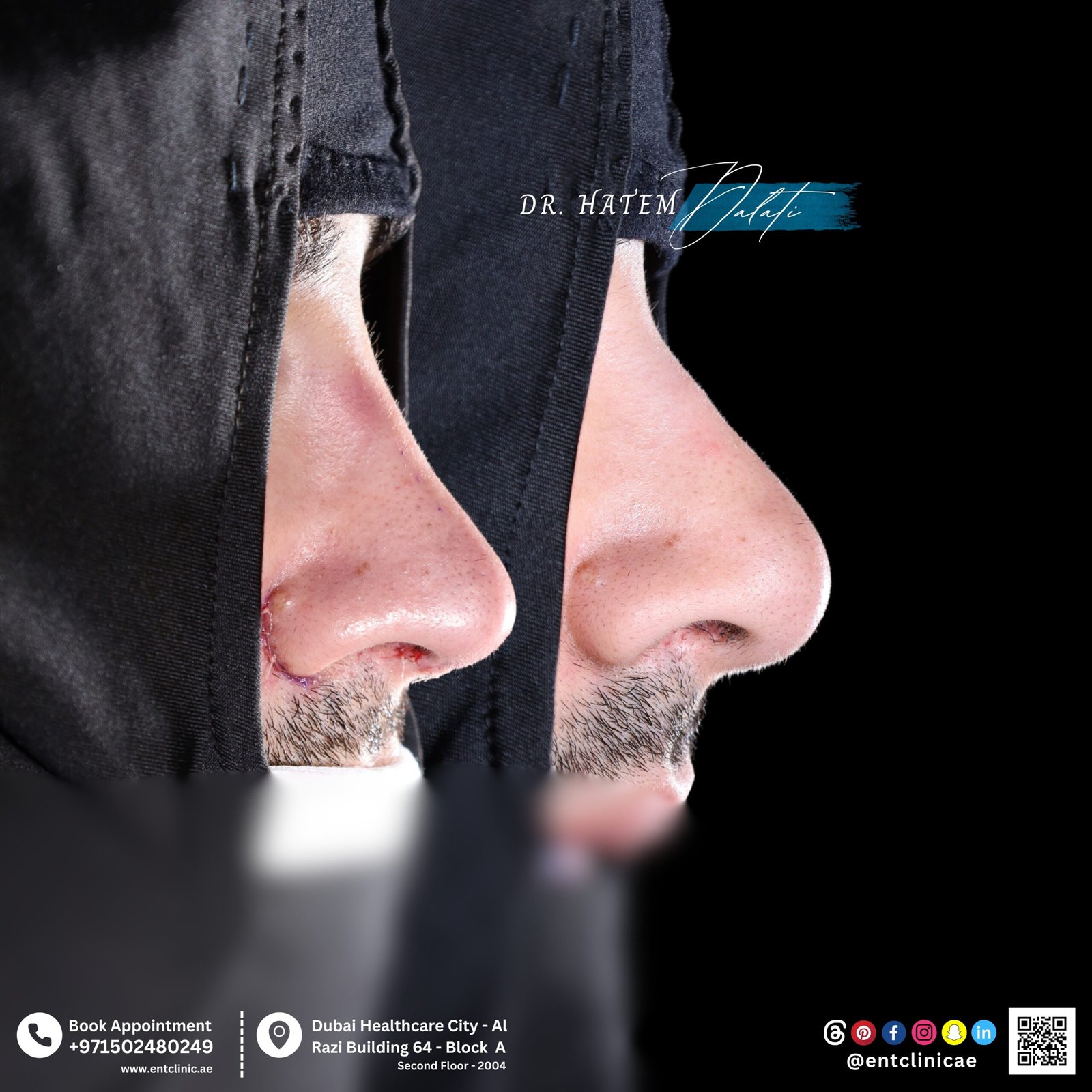 DR HATEM DALATI RHINOPLASTY NOSE JOB REVISION DUBAI UAE NATURAL LOOK PRICE ENT CONSULTANT SURGEON SURGERY