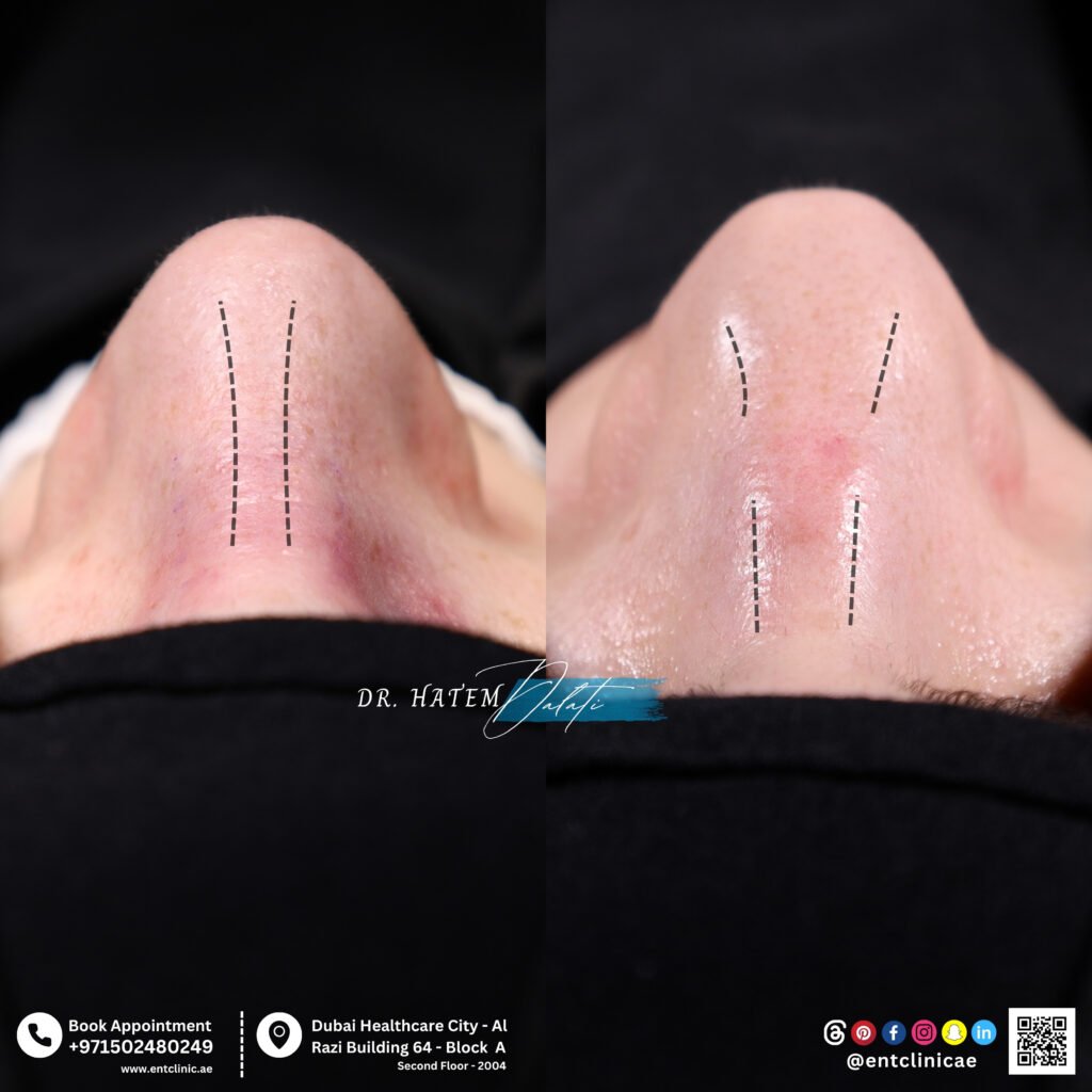 Corrective Rhinoplasty for Asymmetrical Noses – Dr. Hatem Dalati | Best ENT Clinic in Dubai 👃✨