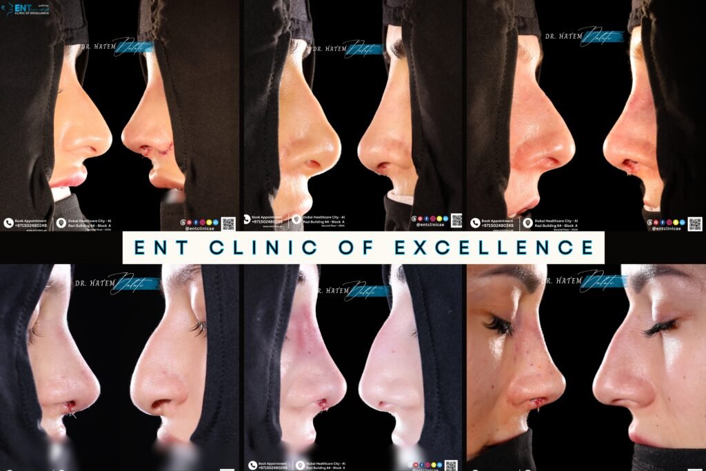 🌟 ما هي أكثر عمليات تجميل الأنف طلبًا؟ نظرة من أفضل عيادة أنف وأذن وحنجرة في دبي 👃✨ 🌟 ما هي أكثر عمليات تجميل الأنف طلبًا؟ نظرة من أفضل عيادة أنف وأذن وحنجرة في دبي 👃✨
