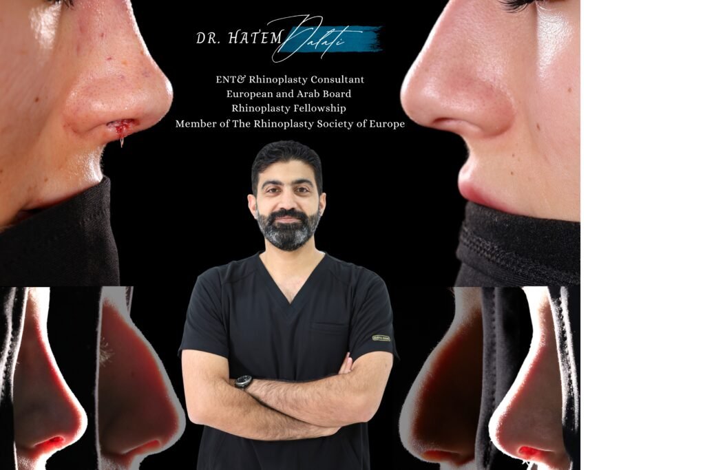 🌟 لماذا يُعد د. حاتم دالاتي الخيار الأمثل لعمليات تجميل الأنف في دبي؟ 👃✨ 🌟 لماذا يُعد د. حاتم دالاتي الخيار الأمثل لعمليات تجميل الأنف في دبي؟ 👃✨