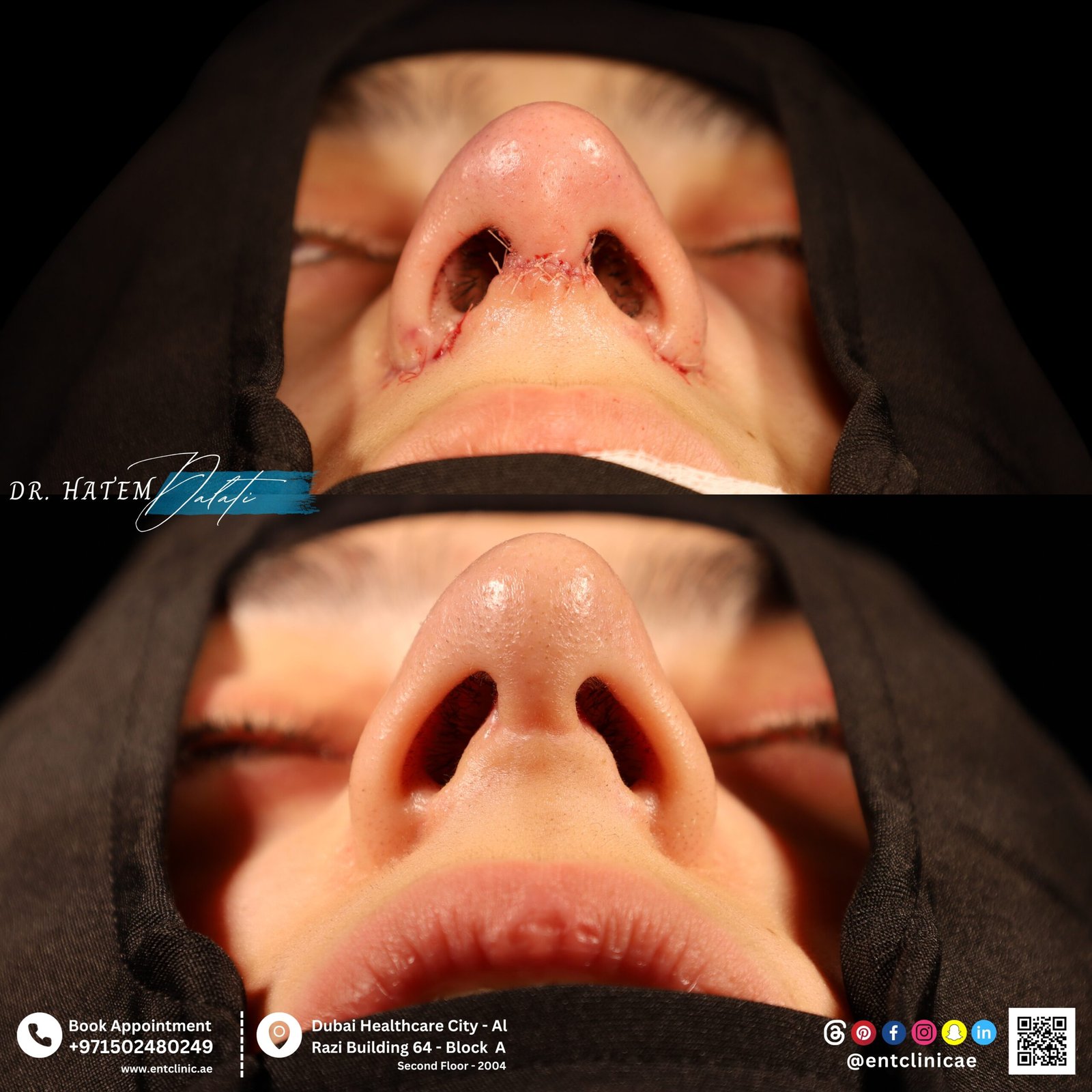 DR HATEM DALATI RHINOPLASTY NOSE JOB REVISION DUBAI UAE NATURAL LOOK PRICE ENT CONSULTANT SURGEON SURGERY