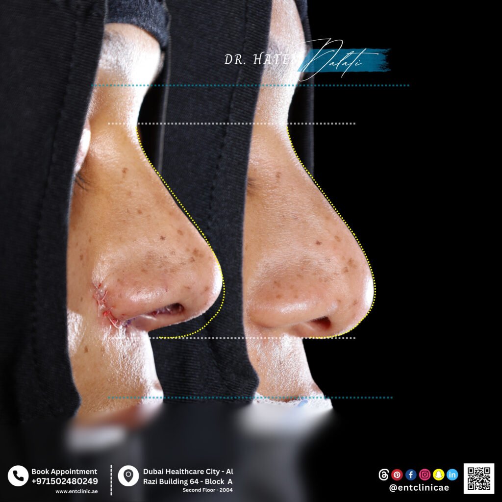ethnic rhinoplasty Dubai preserving natural features