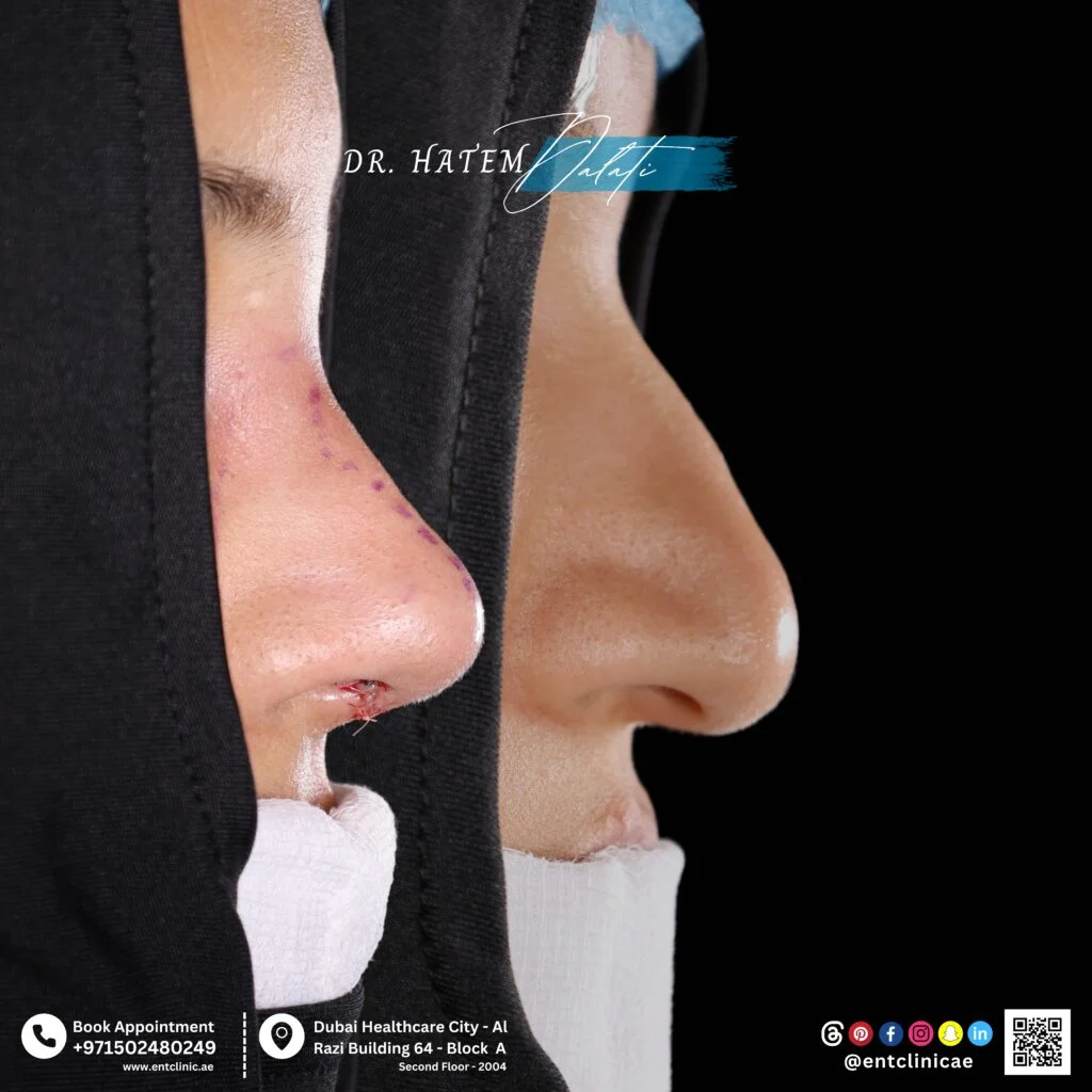 نتائج قبل وبعد عمليات تجميل الأنف لمريض عربي، مع تحسين المظهر الجانبي بشكل طبيعي ومتوازن.