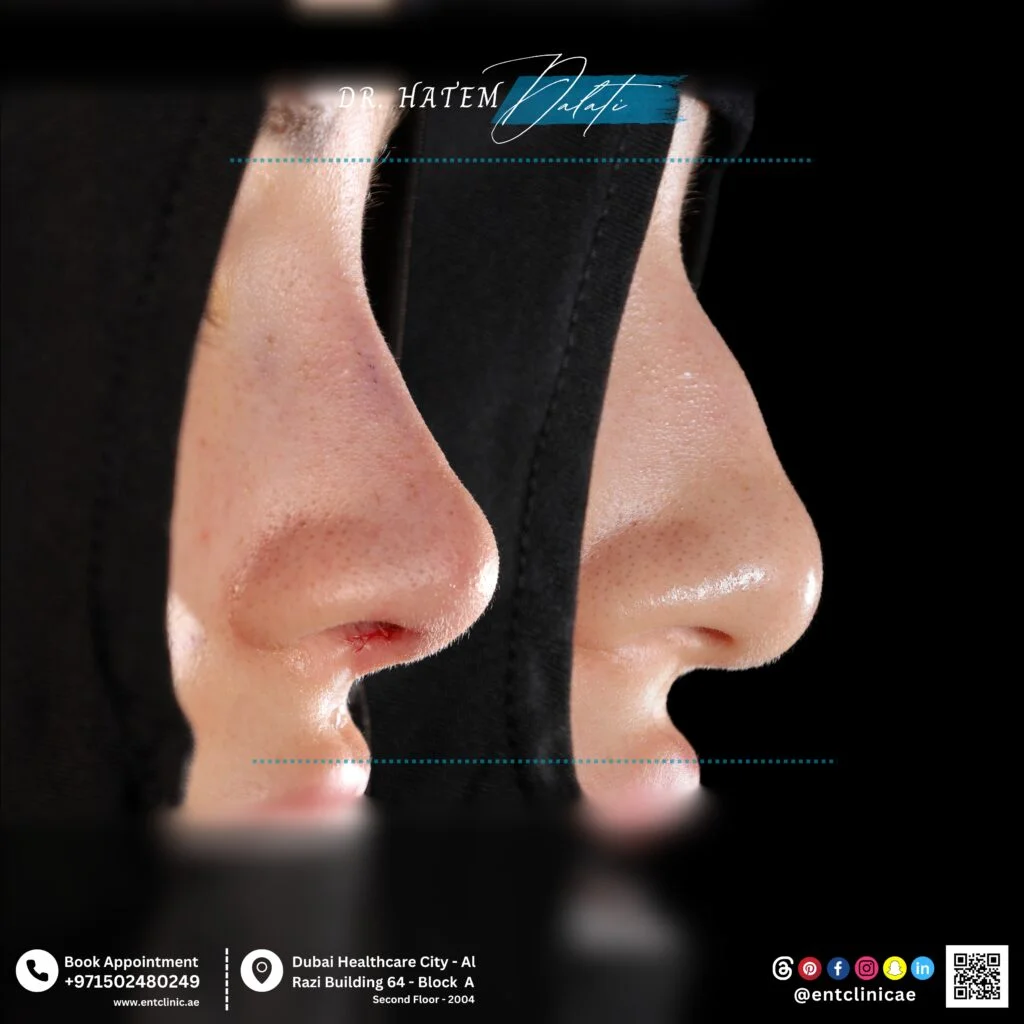 نتائج قبل وبعد عمليات تجميل الأنف لمريض عربي، تُظهر تجميلاً طبيعيًا يحافظ على الهوية العرقية، مع تحسين توازن ملامح الوجه دون تغيير السمات الأساسية.
