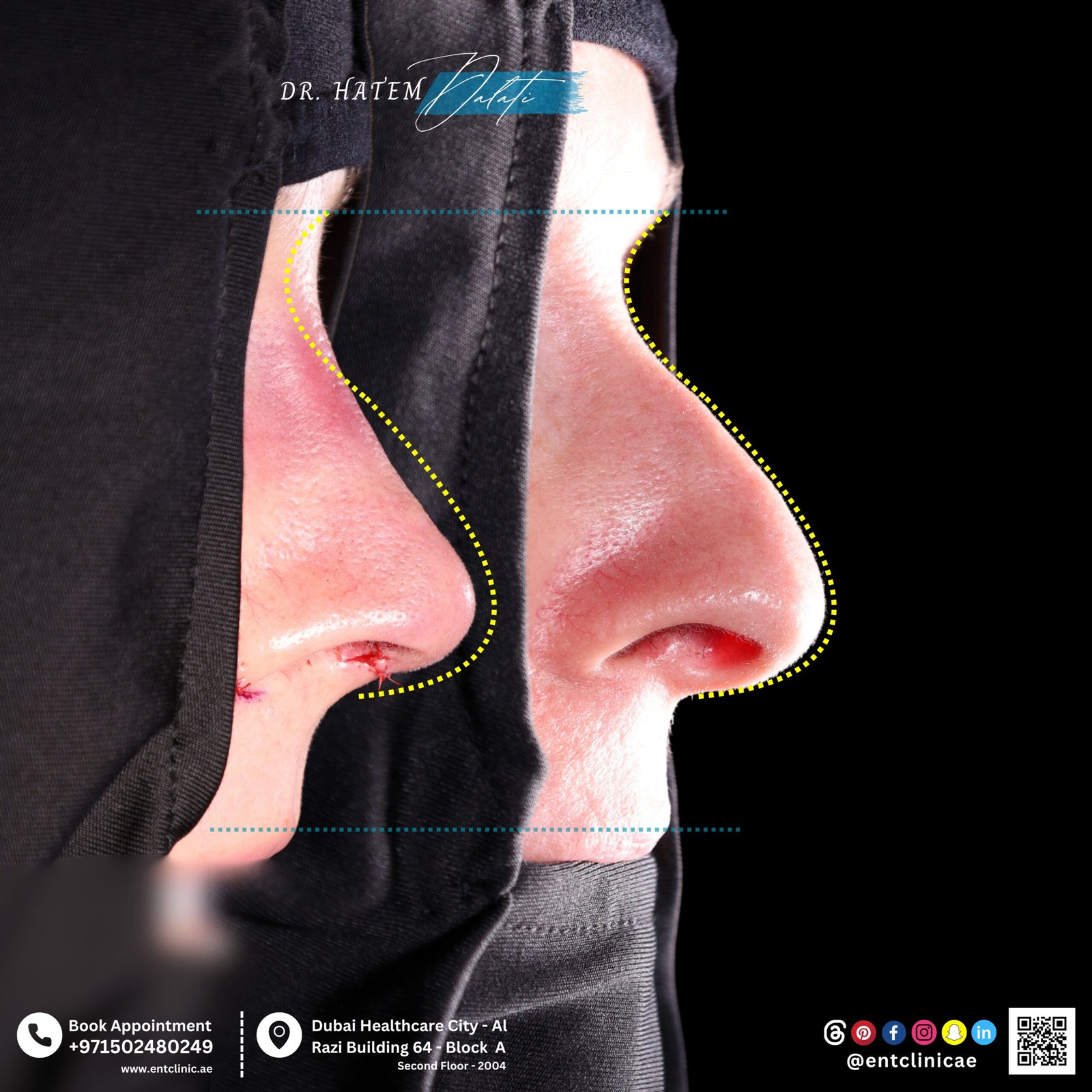 DR HATEM DALATI RHINOPLASTY DUBAI NOSE JOB REVISION UAE ENT CONSULTANT ENT CLINIC OF EXCELLENCE DUBAI HEALTHCARE CITY