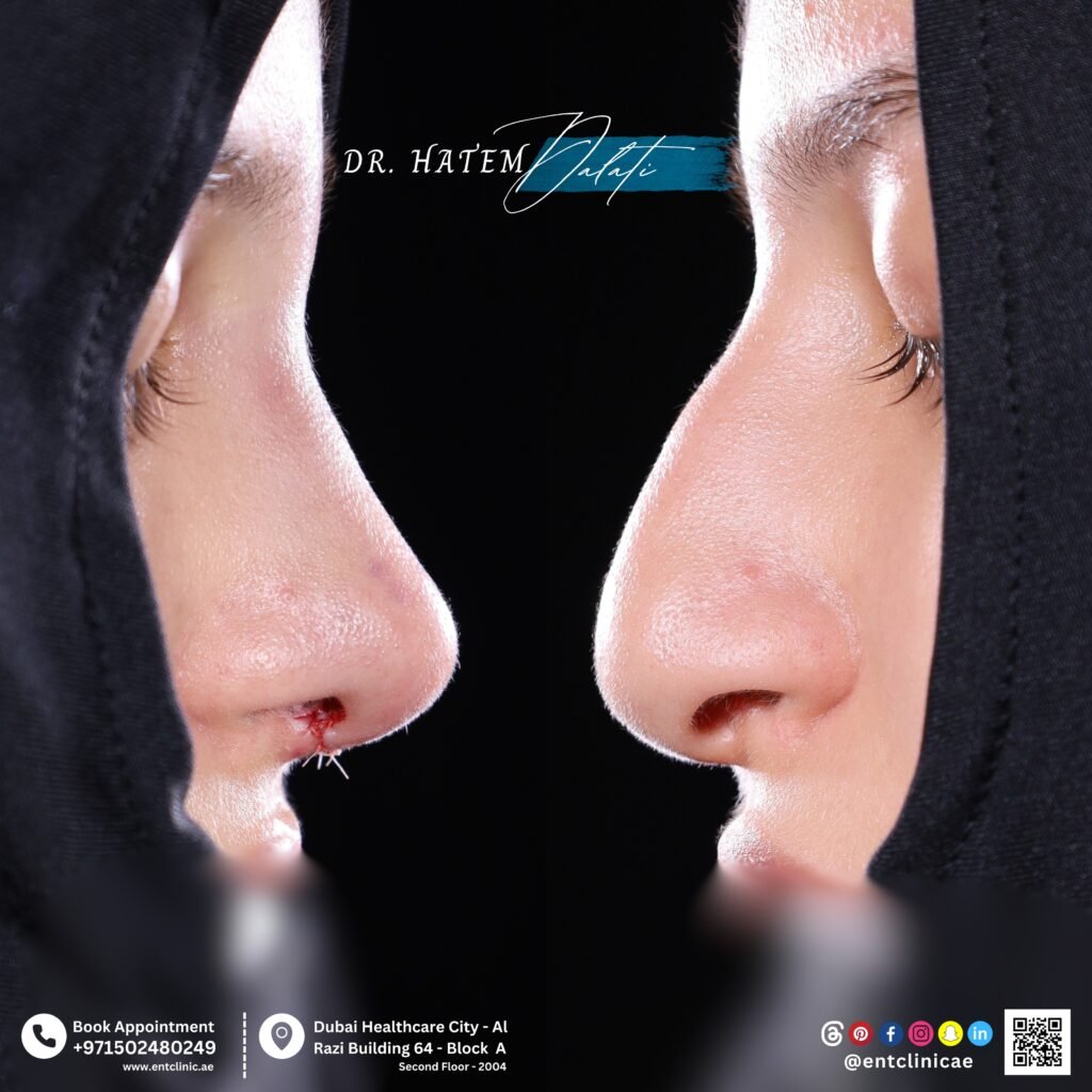 👃 Rhinoplasty for Thick Skin: Surgical Challenges & Solutions in Dubai 💉✨