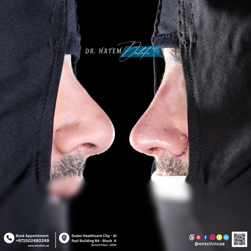 Can You Smoke After a Nose Job? ENT Surgeon in Dubai Explains ๐ซ Can You Smoke After a Nose Job? ENT Surgeon in Dubai Explains ๐ซ