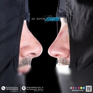 DR HATEM DALATI RHINOPLASTY NOSE JOB REVISION DUBAI UAE NATURAL LOOK PRICE ENT CONSULTANT SURGEON SURGERY