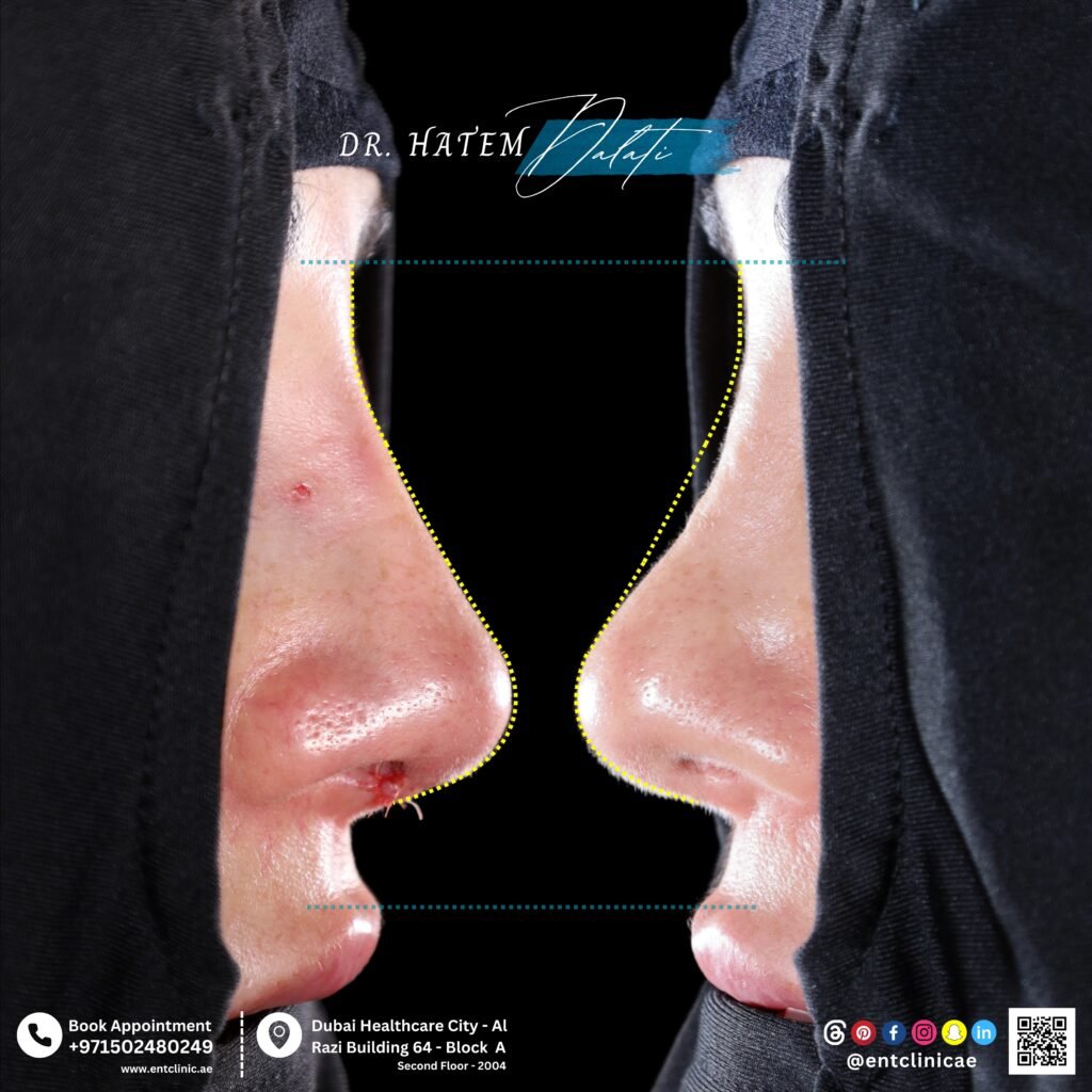 عملية تجميل الأنف التصحيحية لأنف من الشرق الأوسط في دبي مع د. حاتم دالاتي، استشاري الأنف والأذن والحنجرة وجراح تجميل الأنف