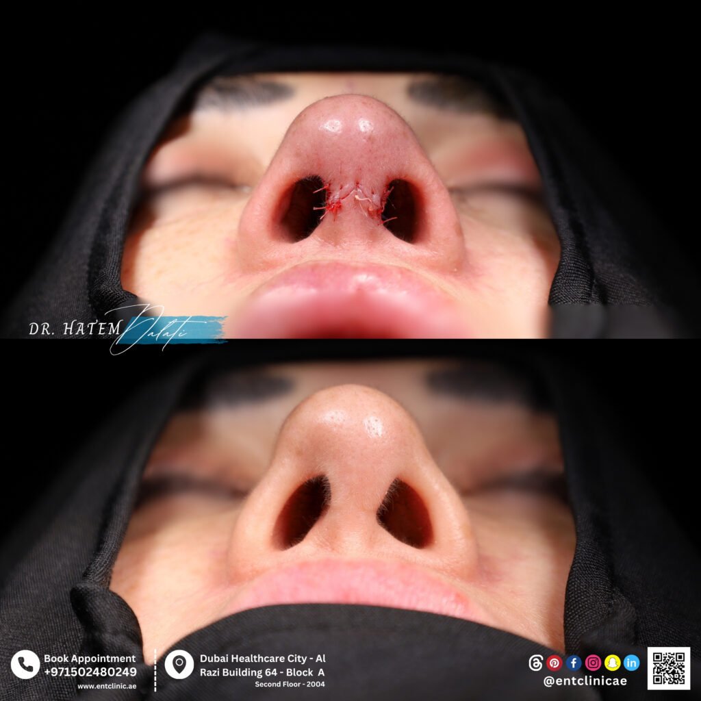عملية تجميل الأنف التصحيحية لأنف من الشرق الأوسط في دبي بإشارف د. حاتم دالاتي، استشاري الأنف والأذن والحنجرة وجراح تجميل الأنف