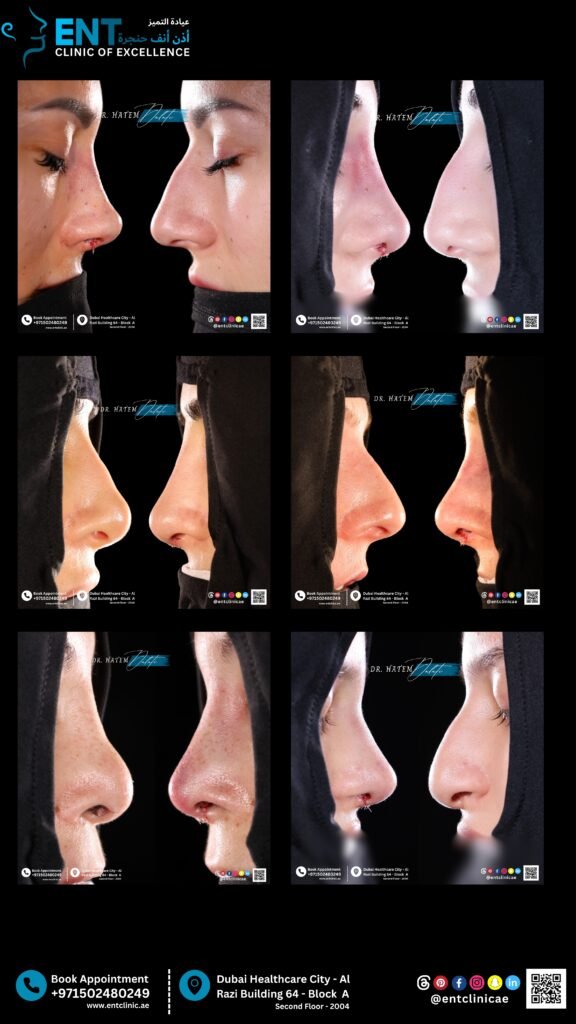 Is This Normal After Rhinoplasty? Common Post-Op Questions Answered by Dubai’s Best ENT Clinic 👃