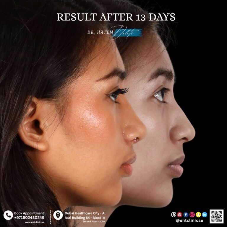 primary rhinoplasty before and after natural results nasal hump reduction and tip refinement in Dubai