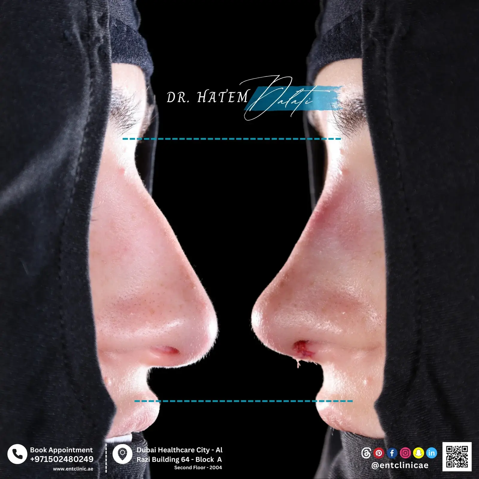 Copy-of-R.-h-DR-HATEM-DALATI-RHINOPLASTY-DUBAI-NOSE-JOB-scaled-2