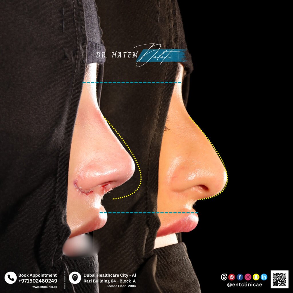 🌟 Natural Rhinoplasty in Dubai 👃✨ | Achieve a Balanced Look with Dr. Hatem Dalati