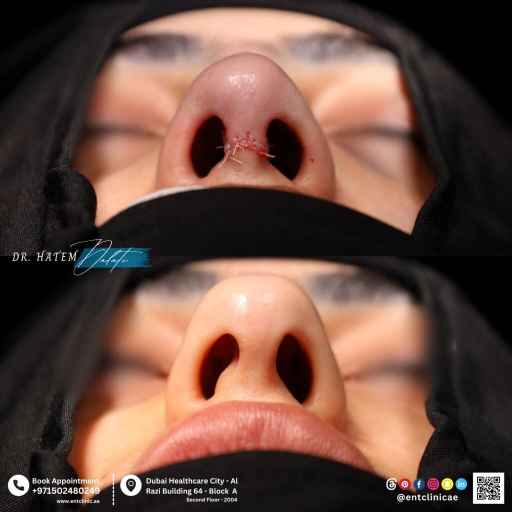 What Will My Nose Look Like After Rhinoplasty? Expert Insights from Dubai ENT & Rhinoplasty Surgeon What Will My Nose Look Like After Rhinoplasty? Expert Insights from Dubai ENT & Rhinoplasty Surgeon