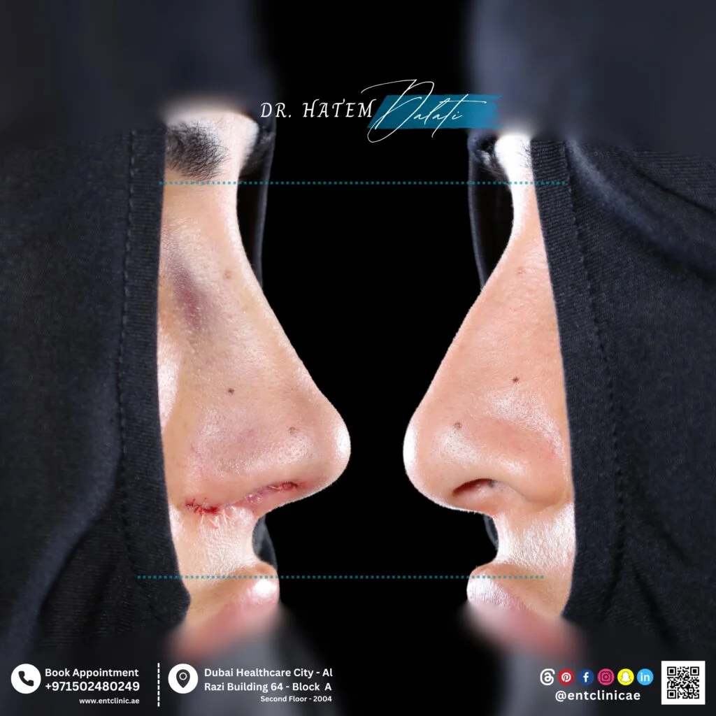 دليل يوضح مخاطر ومضاعفات تجميل الأنف في دبي مثل العدوى ومشاكل التنفس والمضاعفات، مع شرح نسبة الأمان وكيف يقلل جرّاح الأنف والأذن والحنجرة المخاطر بشكل كبير جدا