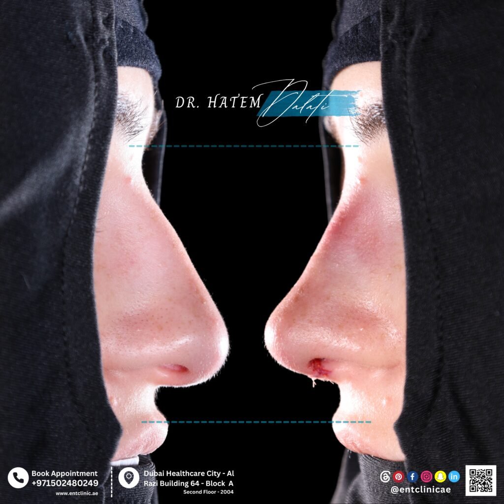 Is Rhinoplasty a Simple Surgery in Dubai?
