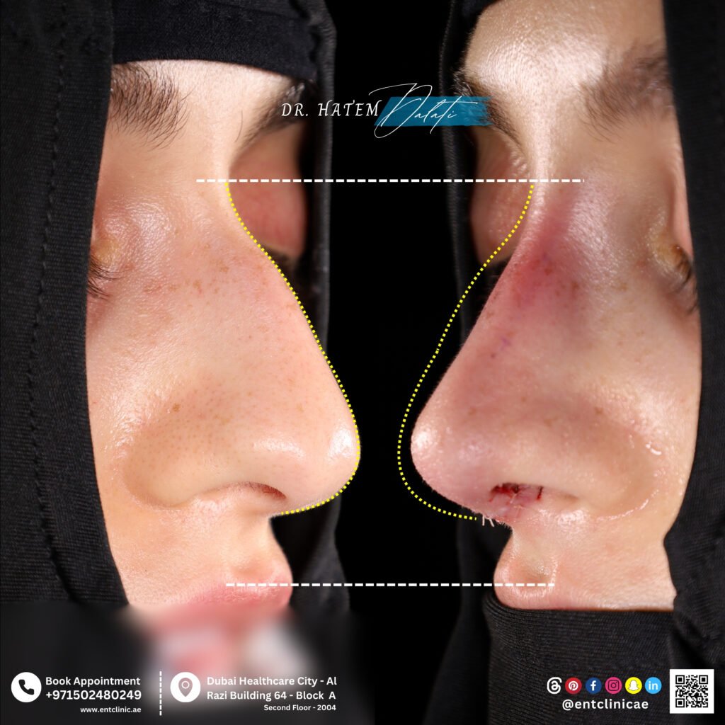 Can Rhinoplasty Fix a Crooked Nose, Deviated Septum, or Nose Hump in Dubai? | Dr. Hatem Dalati