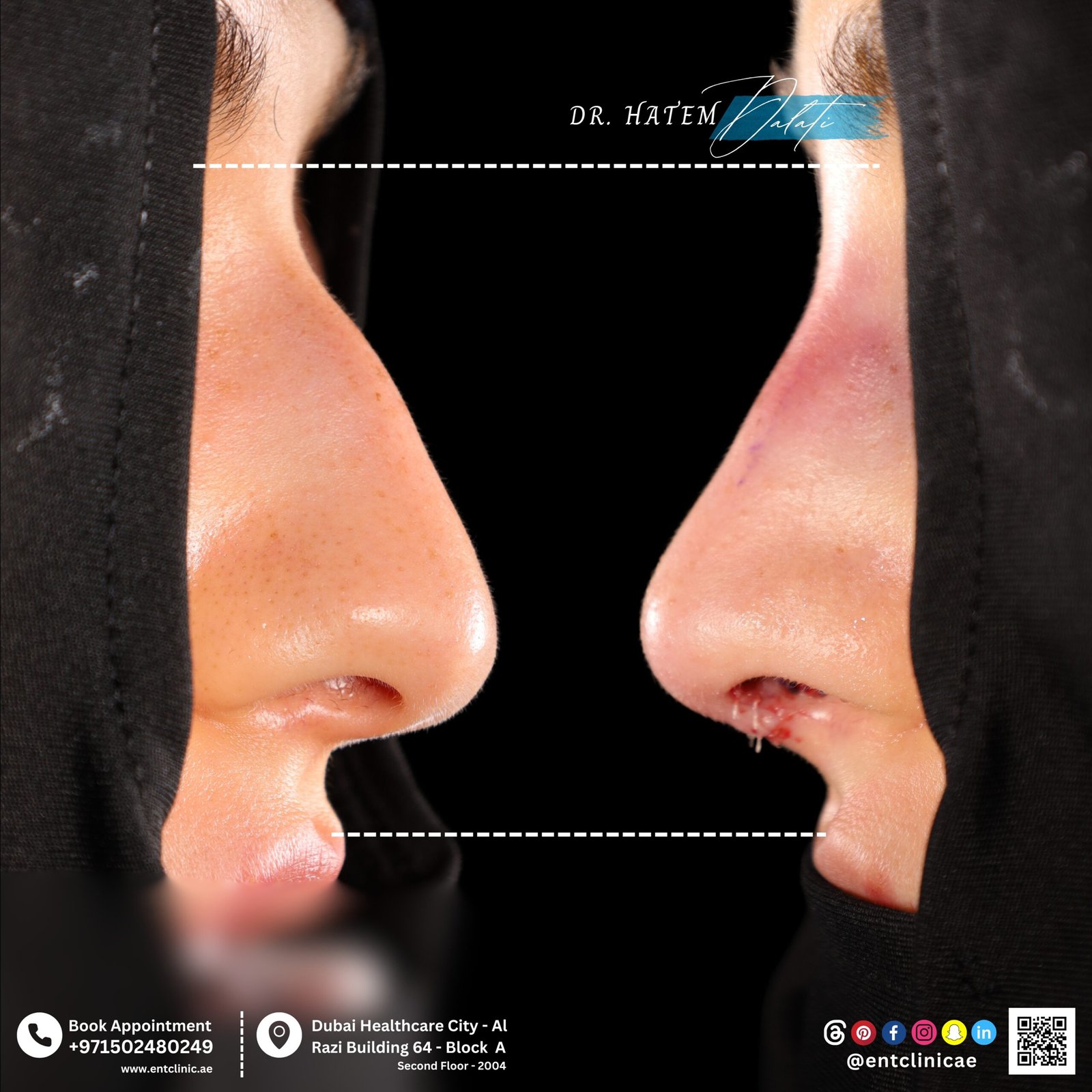 DR HATEM DALATI RHINOPLASTY DUBAI NOSE JOB (6)