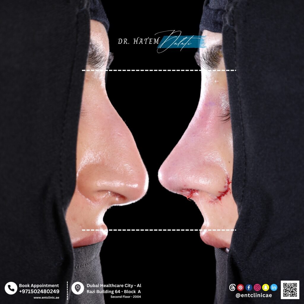 هل أنا مرشح مناسب لعملية تجميل الأنف في دبي؟ ✅ العمر المثالي ونصائح الخبراء من د. حاتم دالاتي