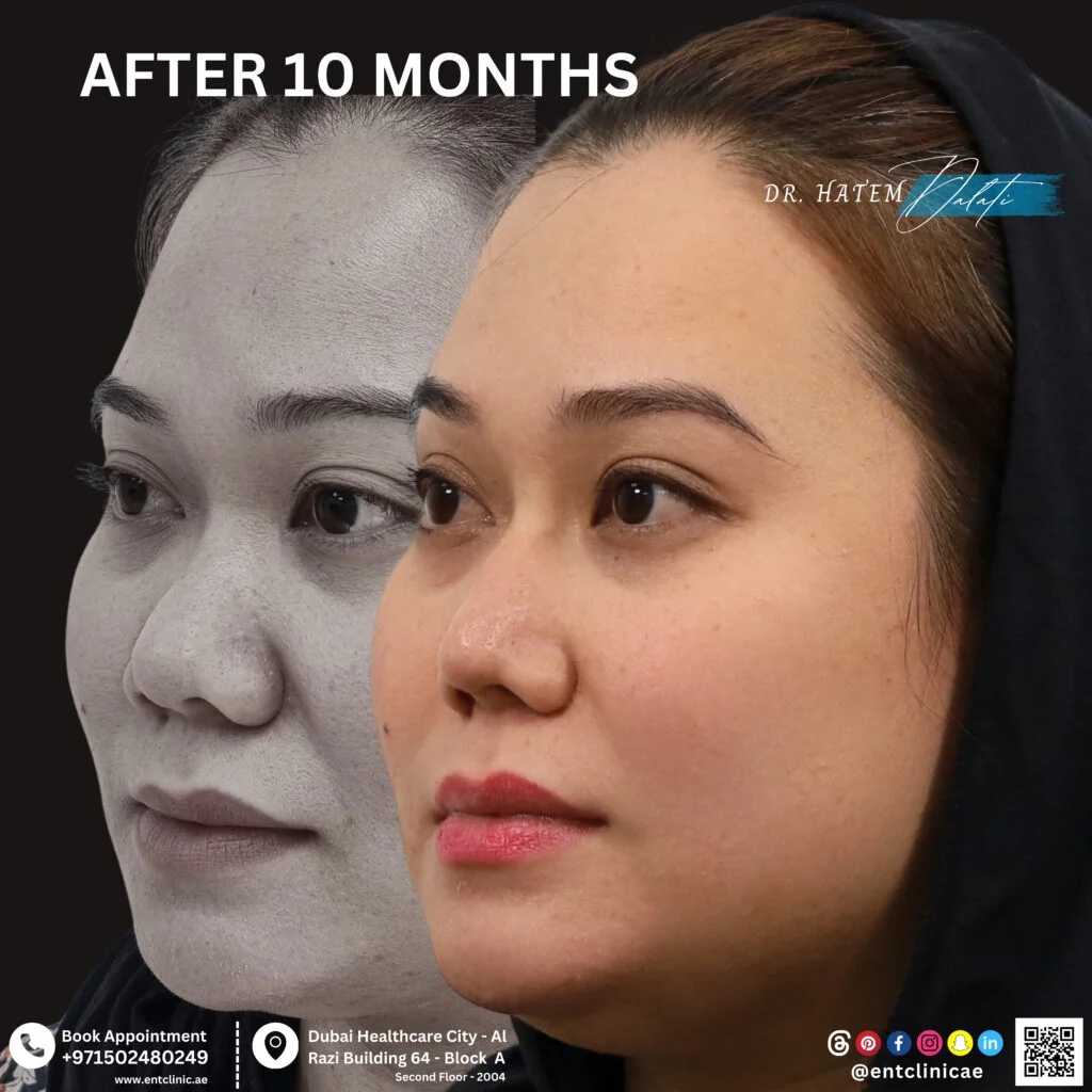 تجميل الأنف الآسيوي قبل وبعد عملية إعادة تشكيل الأنف في دبي مع د. حاتم دالاتي، مع إظهار تحسين تحديد طرف الأنف وزيادة بروز جسر الأنف مع الحفاظ على الملامح العرقية الطبيعية وتناسق الوجه
