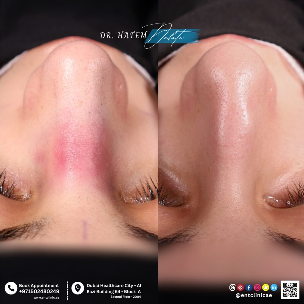 severe deviated nose with dorsal hump before and after rhinoplasty correction Dubai Dr Hatem Dalati