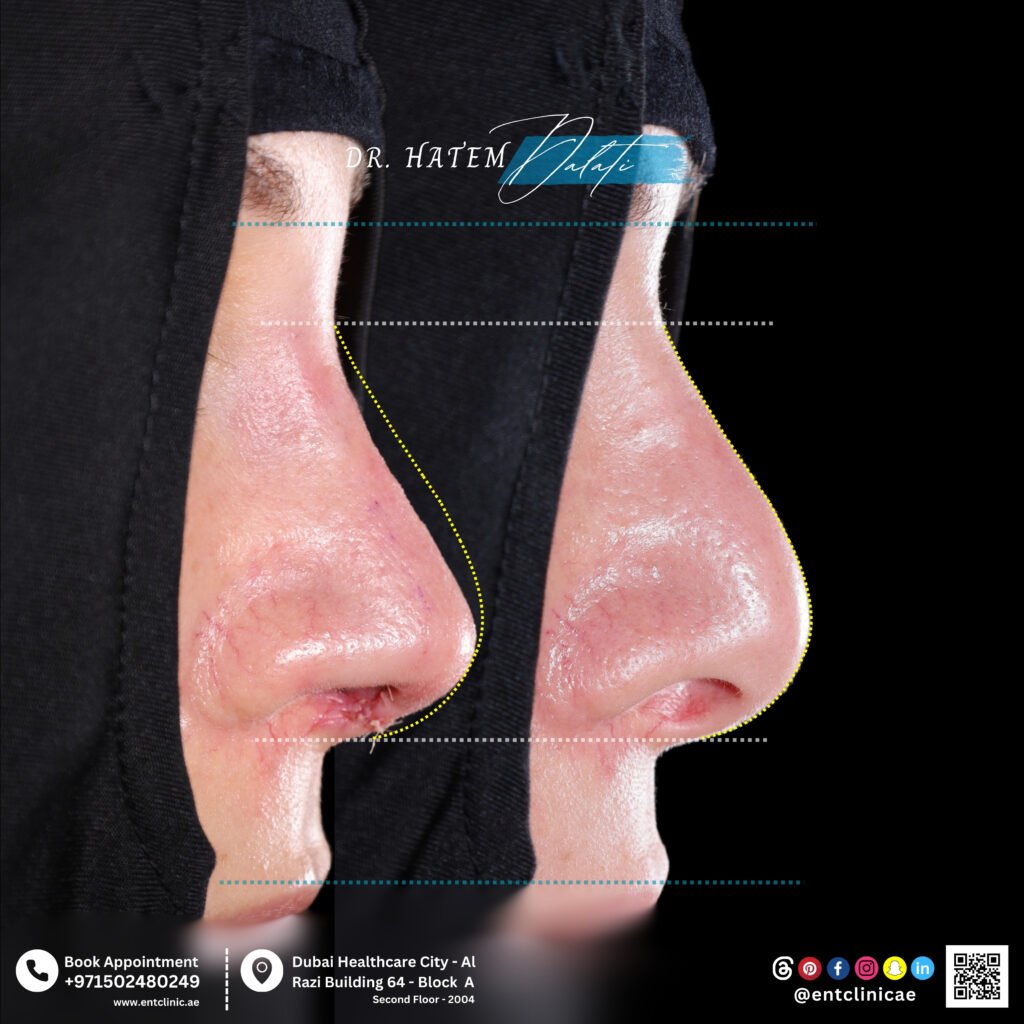before and after profile view revision rhinoplasty for polybeak deformity