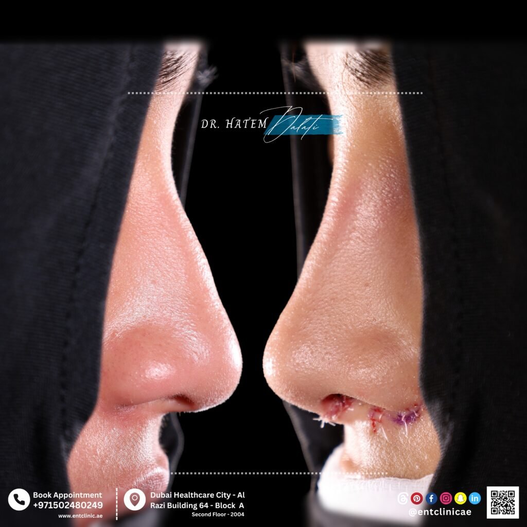 Can Nose Fillers Fix Breathing Problems? Expert Insights by Dr. Hatem Dalati in Dubai Can Nose Fillers Fix Breathing Problems? Expert Insights by Dr. Hatem Dalati in Dubai