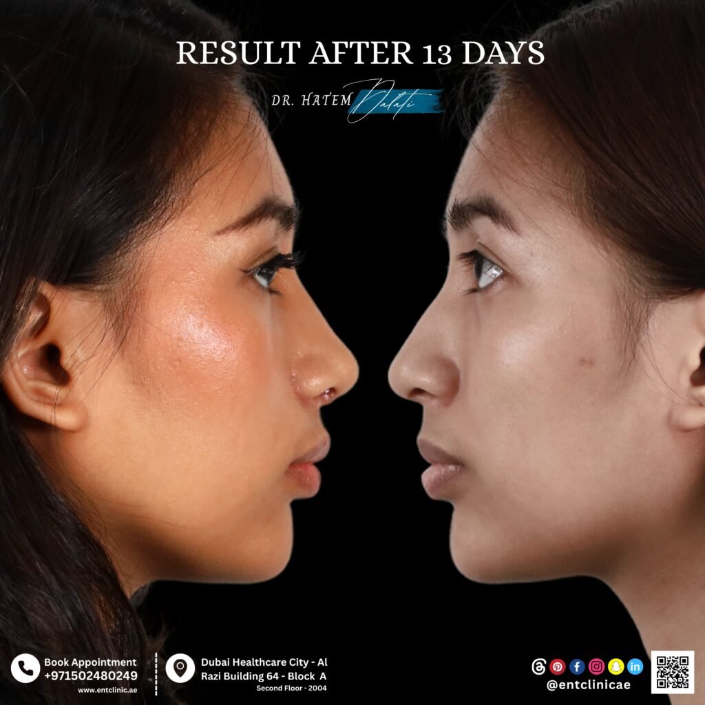 هل أحتاج فعلاً إلى عملية تجميل الأنف؟ | نصائح طبية من د. حاتم دالاتي – استشاري تجميل الأنف في دبي هل أحتاج فعلاً إلى عملية تجميل الأنف؟ | نصائح طبية من د. حاتم دالاتي – استشاري تجميل الأنف في دبي