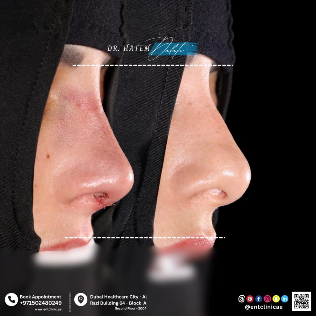 What is Septorhinoplasty? and How Does It Improve Your Nose and Breathing?