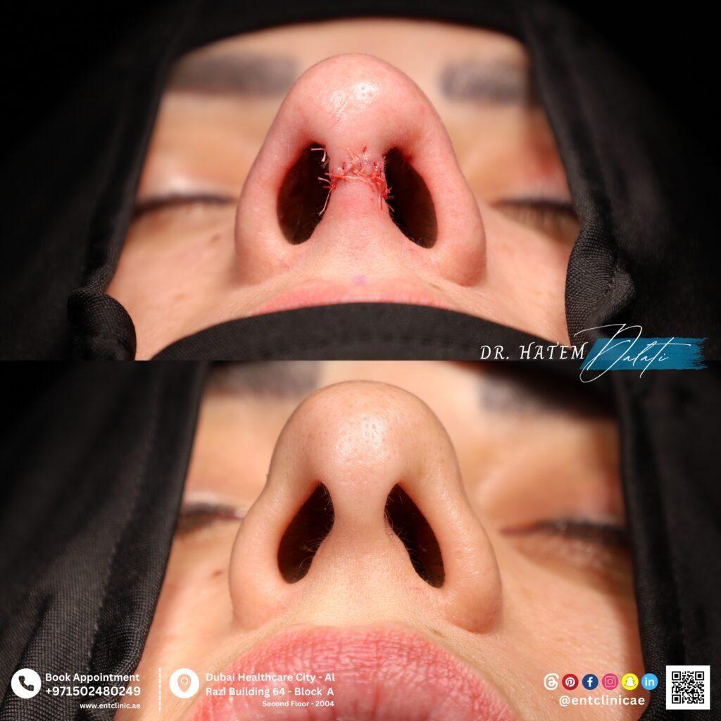 ماذا يجب فعله قبل عملية تجميل الأنف في دبي: دليل التحضير الأساسي