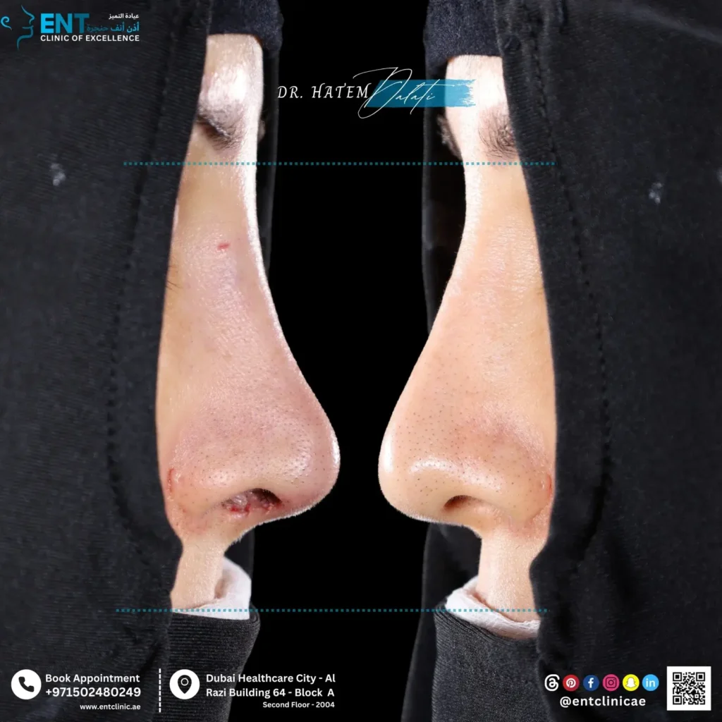 ما هي مخاطر ومضاعفات تجميل الأنف في دبي؟ رؤى خبير أنف وأذن وحنجرة حول السلامة والعدوى ما هي مخاطر ومضاعفات تجميل الأنف في دبي؟ رؤى خبير أنف وأذن وحنجرة حول السلامة والعدوى