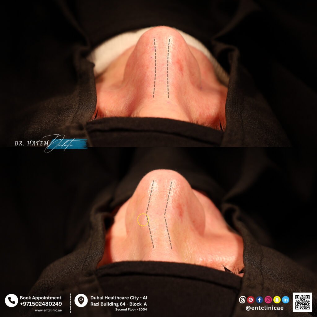 Can Rhinoplasty Fix My Fractured Nose? Expert Insights by Dr. Hatem Dalati in Dubai Can Rhinoplasty Fix My Fractured Nose? Expert Insights by Dr. Hatem Dalati in Dubai