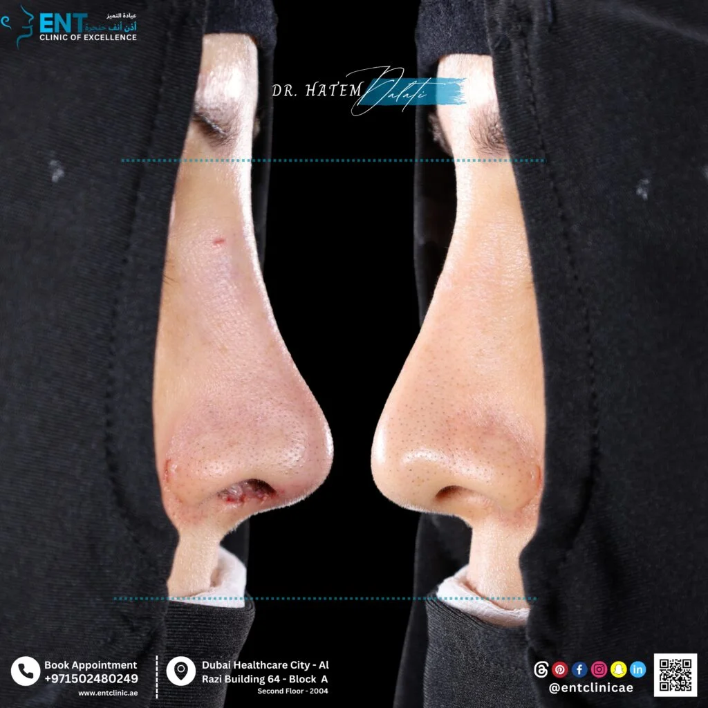مريضة في الأربعينيات من عمرها خضعت لعملية تجميل الأنف آمن بعد تقييم طبي شامل محققًا نتائج متوازنة وطبيعية المظهر.