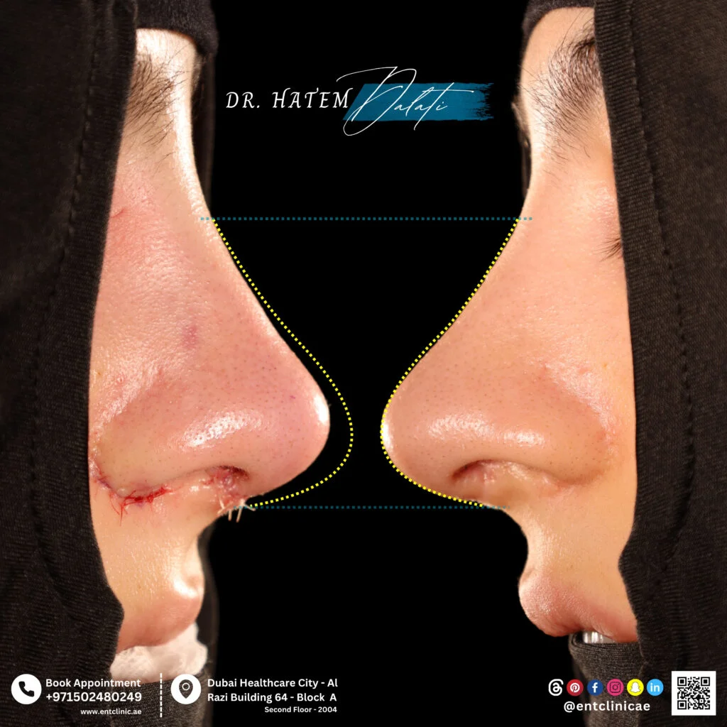 صور قبل وبعد لعملية تجميل الأنف تُظهر تصحيح الأنف البارز مع تحسين طرف الأنف واستخدام طُعوم غضروفية بواسطة د. حاتم دالاتي، استشاري الأنف والأذن والحنجرة في دبي.