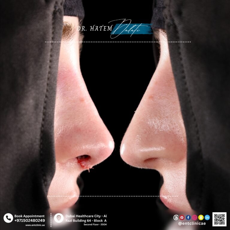 DR HATEM DALATI RHINOPLASTY DUBAI NOSE JOB REVISION UAE ENT CONSULTANT ENT CLINIC OF EXCELLENCE DUBAI HEALTHCARE CITY