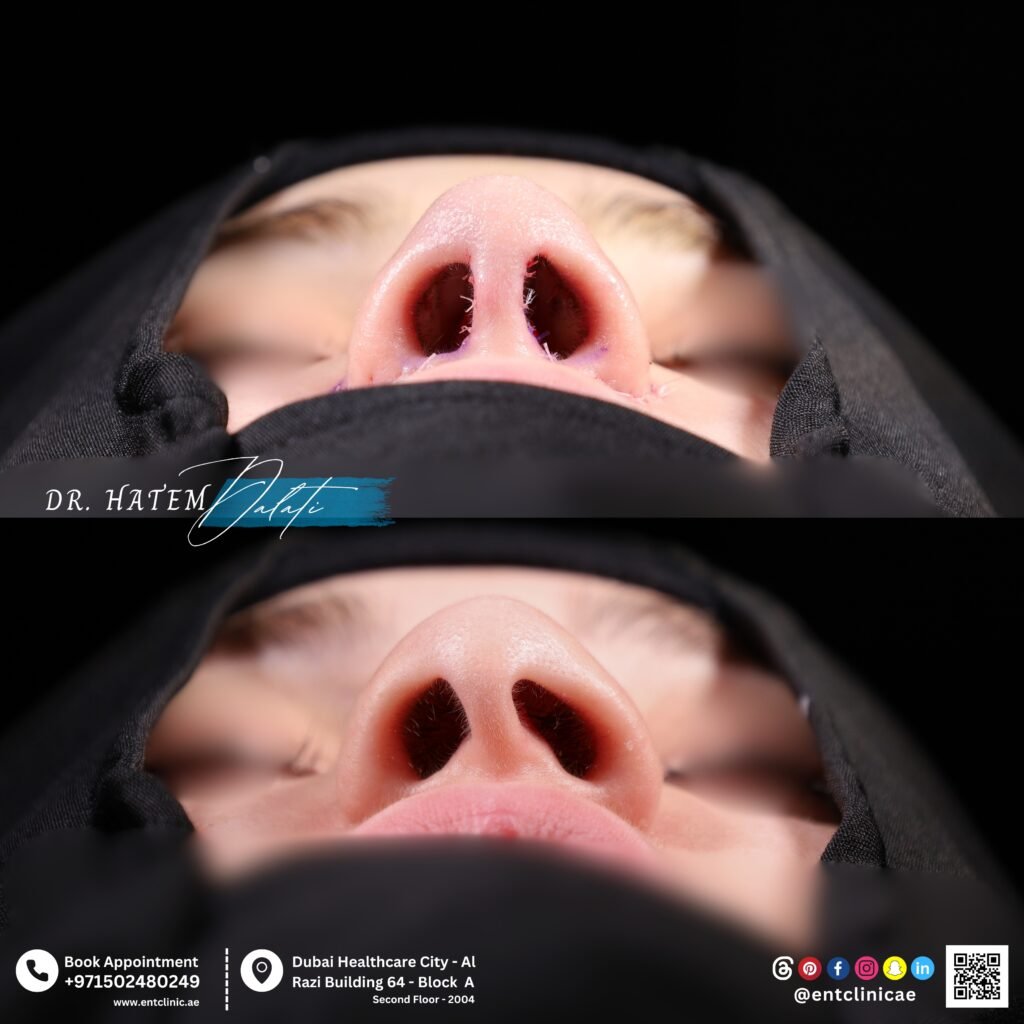 Nostril asymmetry rhinoplasty Dubai before and after showing improved nostril symmetry and refined nasal tip