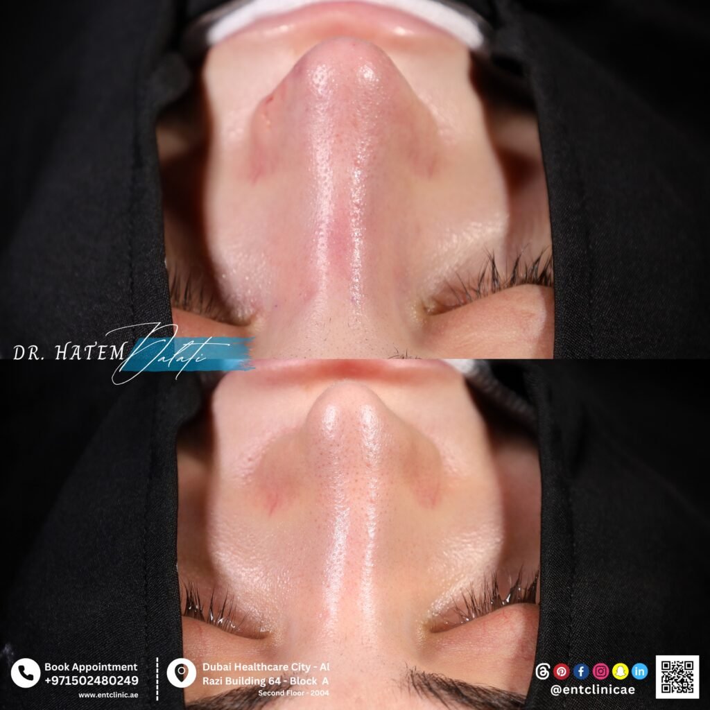 من زاوية القاعدة قبل وبعد عملية تصحيح الحاجز الأنفي مع تجميل الأنف، مع إبراز تحسن تناسق فتحات الأنف وتوازن شكل طرف الأنف.