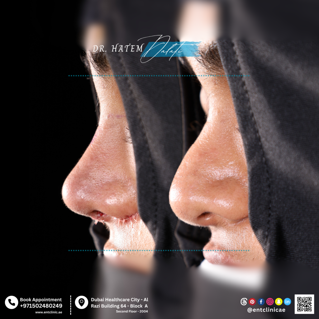 تصحيح انحراف الأنف مع تحسين وتحديد طرف أنف متضخم ومتدلٍ  مع تحسين وظيفي لتعزيز عملية التنفس.