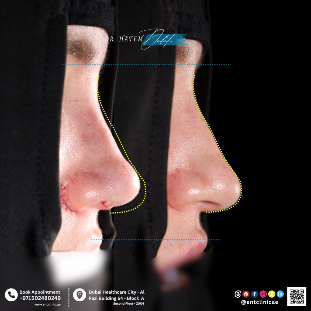 How Is Rhinoplasty Performed? A Step-by-Step Guide by Dr. Hatem Dalati